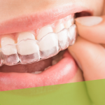 SureSmile Aligners